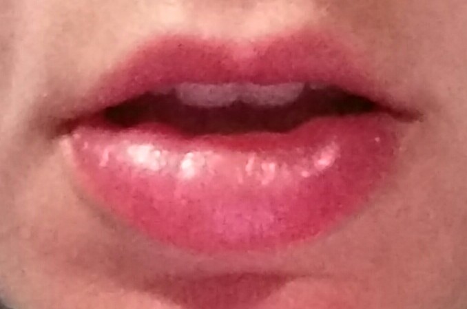 File:Actinic Cheilitis Photo.jpg