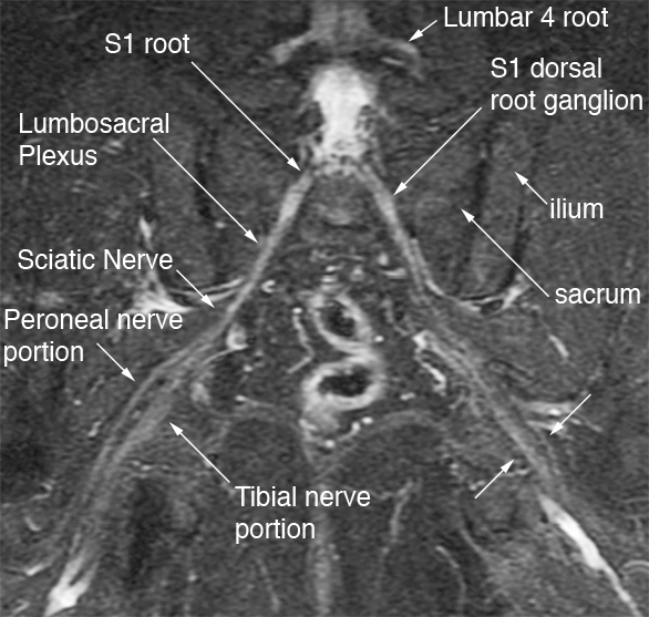 File:Bilateral Sciatic Neurography.jpg