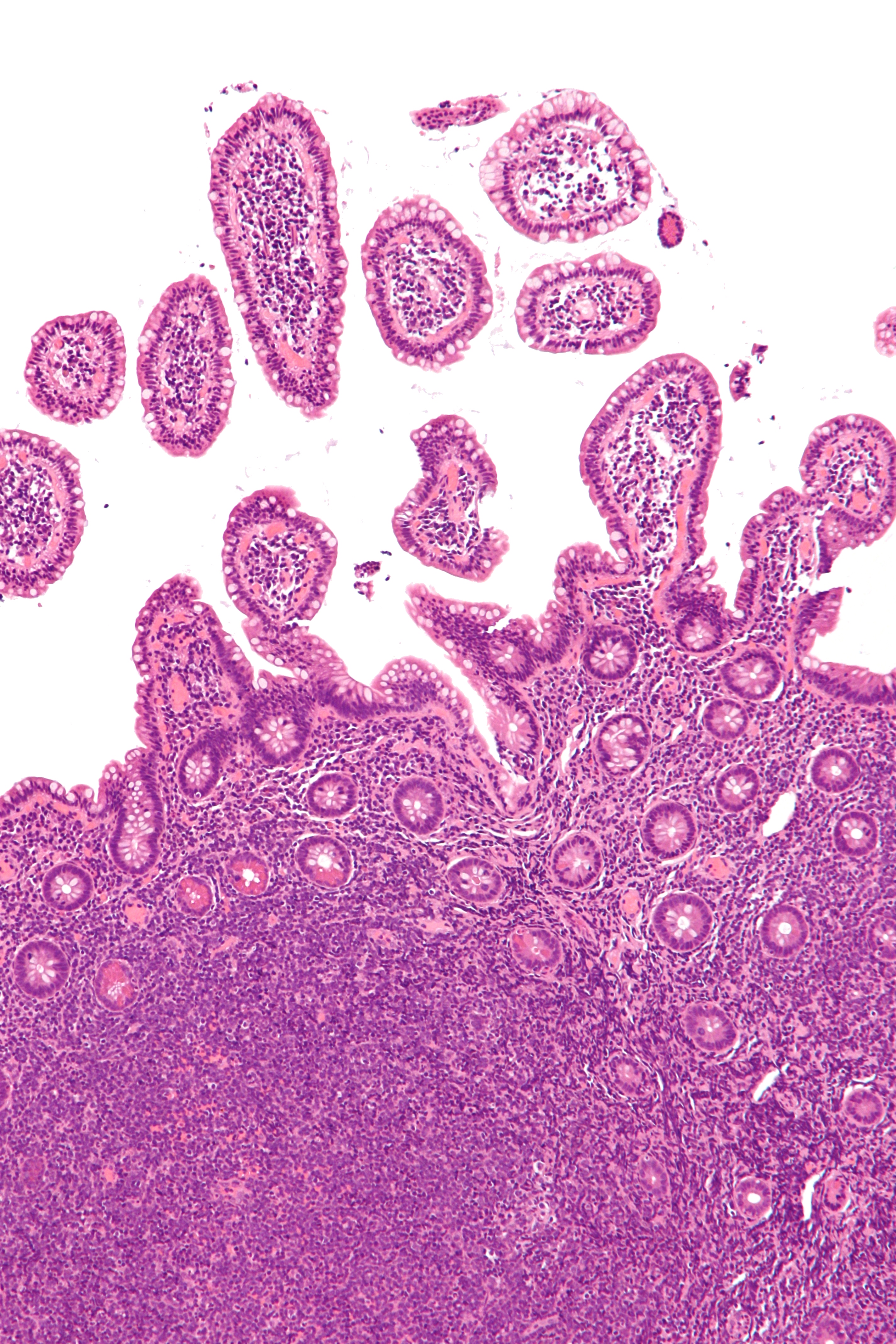 Micrograph of mantle cell lymphoma