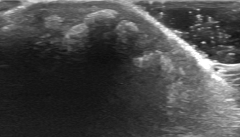 File:Tumerous calcinosis 0001.jpg