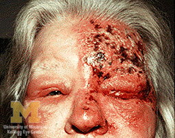 File:Trigeminal herpes with uveitis and keratitis.jpg