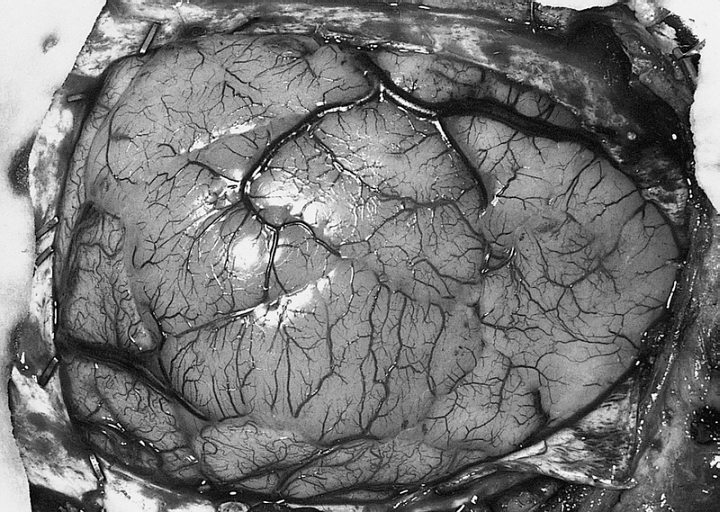 File:405550-Gross-ANAPLASTIC ASTROCYTOMA.jpg