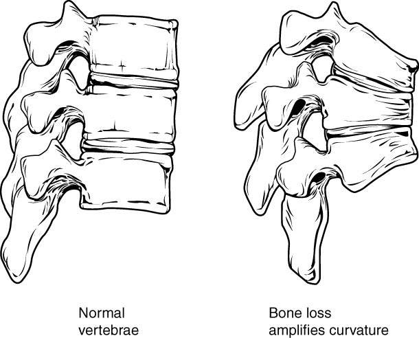 File:722 Feature Osteoprosis of Spine.jpg