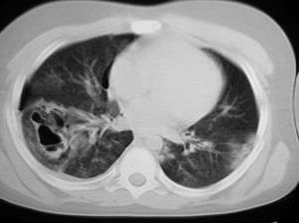 File:Pulmonary contusion pseudocyst CT.jpg