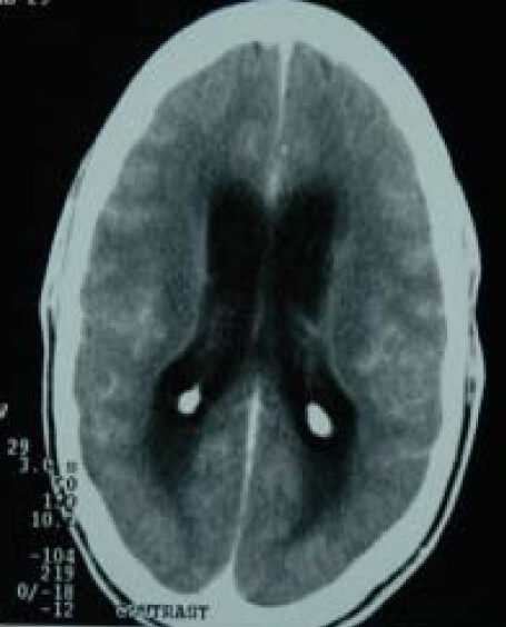 File:Tuberculous-meningitis-scan.jpg