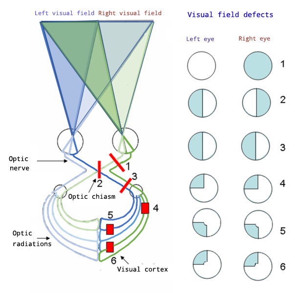 File:Hemianopsia en.jpg