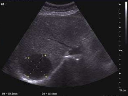File:Ultrasonography of a liver cyst.jpg