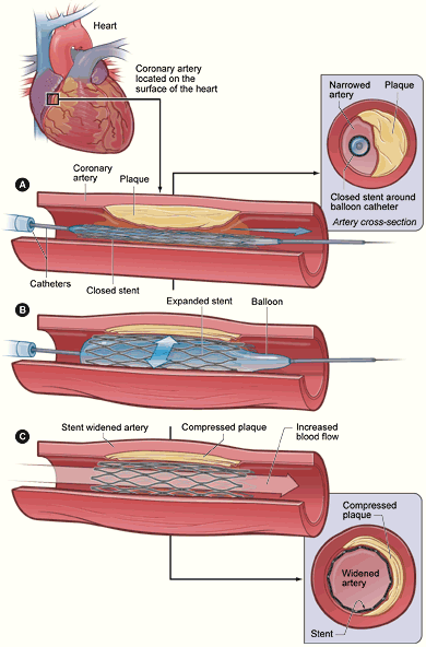 File:PTCA stent NIH.gif