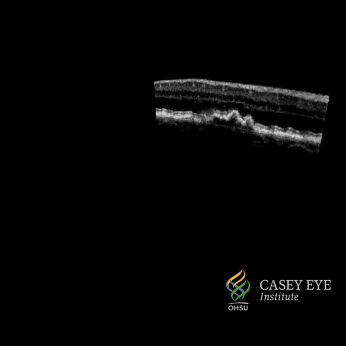 File:Optical coherence tomography of human retina.gif
