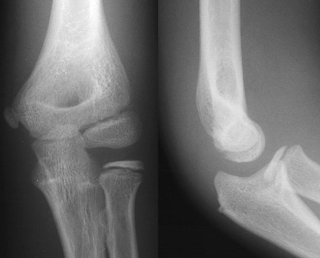 File:Ap lateral elbow.jpg