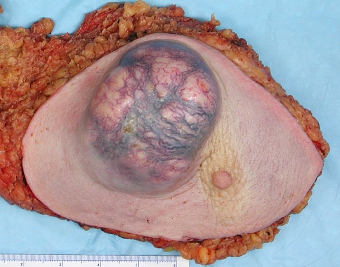 File:BreastCancer.jpg