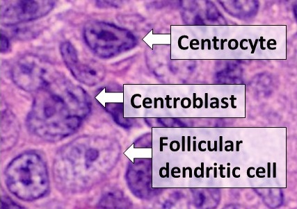 File:Centrocyte, centroblast and follicular dendritic cell in a follicular lymphoma.jpg