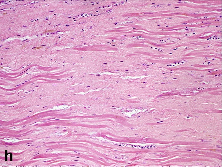 File:Histopathology of dense fibrous scar replacing myocyte loss in myocardial infarction.jpg