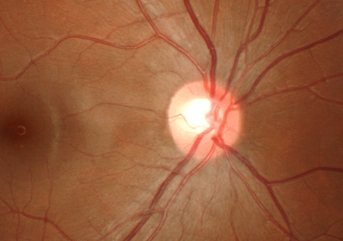 File:Optic cup and macula - 3D motion parallax.gif