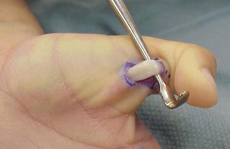 File:A1 Pulley release.jpg