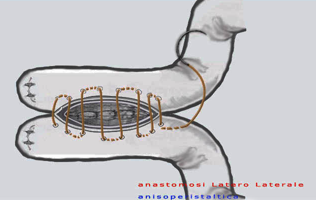 File:Anastomosi LL2.png