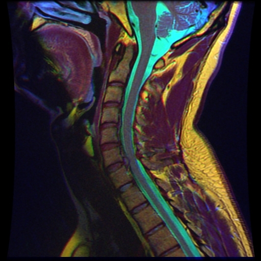 File:06 Cervical MRI scan R T1WFSE G T2WfrFSE STIR B.jpg
