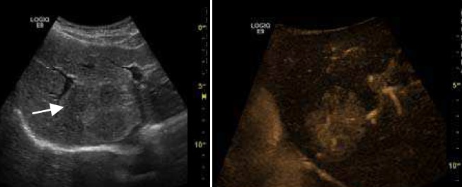 File:Contrast-enhanced ultrasound of focal nodular hyperplasia.jpg