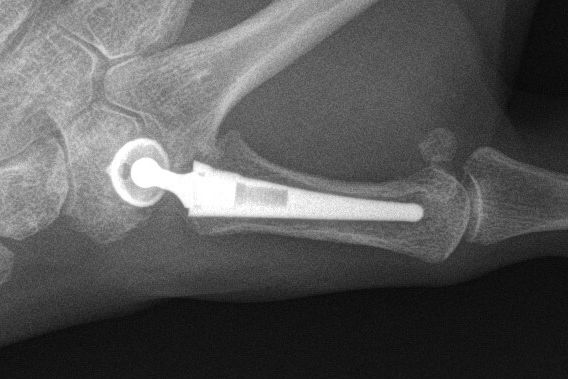File:X-ray of trapeziometacarpal joint replacement, F, cropped.jpg