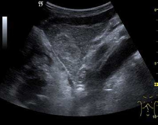 File:Ultrasonography of a hepatic hemangioma.jpg