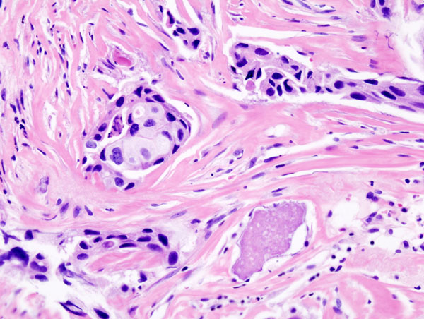 File:Breast invasive scirrhous carcinoma histopathology (1).jpg