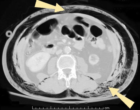 File:Subcutaneous emphysema abdomen arrows2.jpg