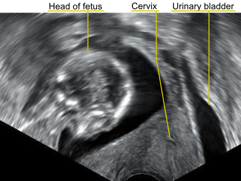 File:Retroverted uterus in pregnancy.png