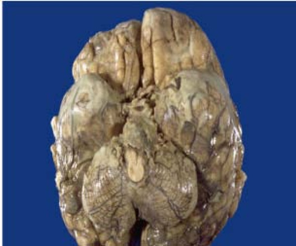 File:Tuberculous-meningitis-autopsy.jpg