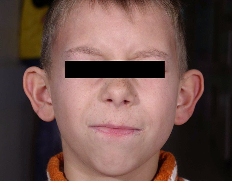 File:Otopexy prae.jpg