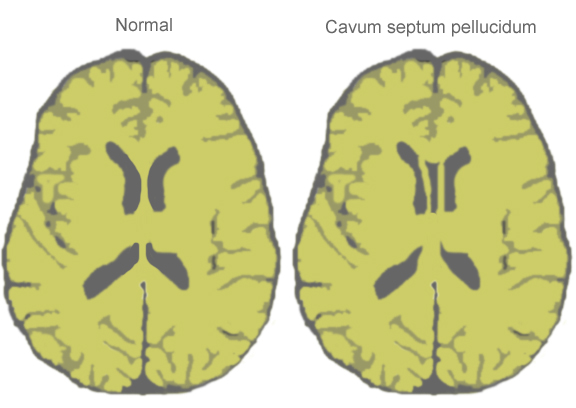 File:CavumSeptumPellucidumDiagram.jpg