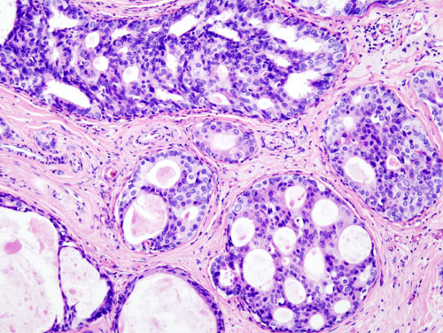 File:Breast DCIS histopathology (1).jpg