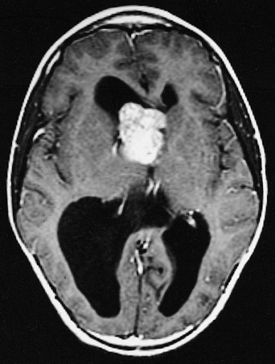 File:MRI of brain with sub-ependymal giant cell astrocytoma.jpg