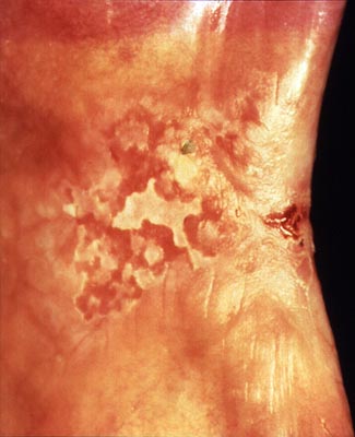 File:NIH DOC 19 Erythroleukoplakia.jpg
