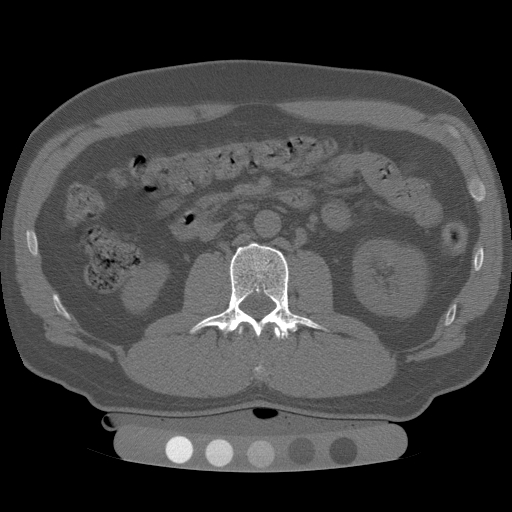 File:Image of trabecular bone of the spine by Quantitative computed tomography.jpg