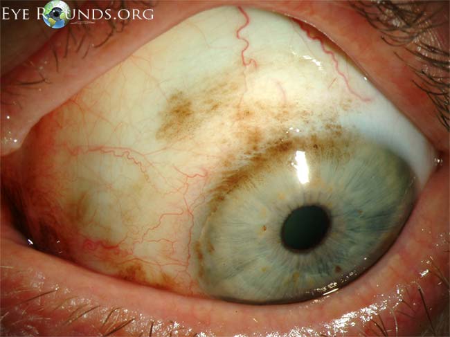 File:Primary-acquired-melanosis.jpg