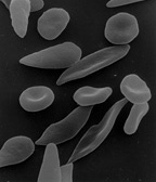 File:Sicklecells.jpg