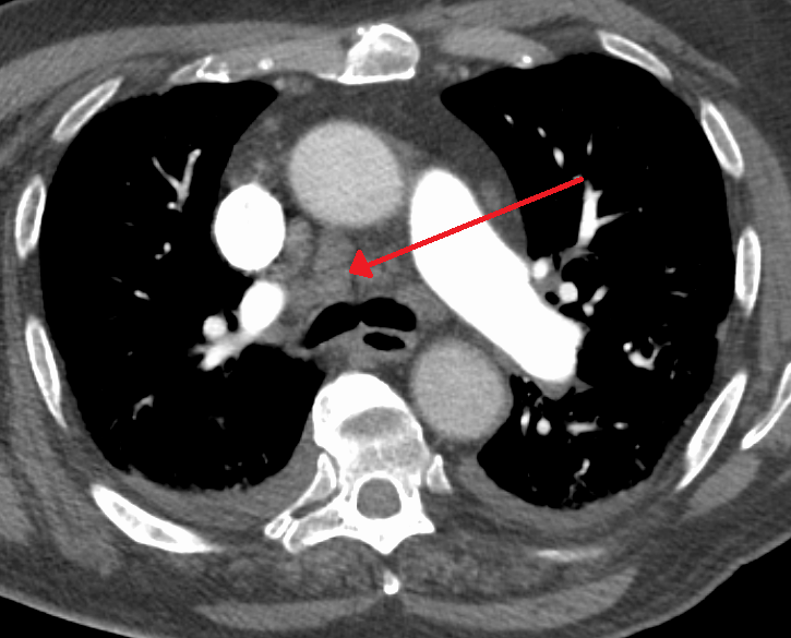 File:Mediastinaladenopathy.png