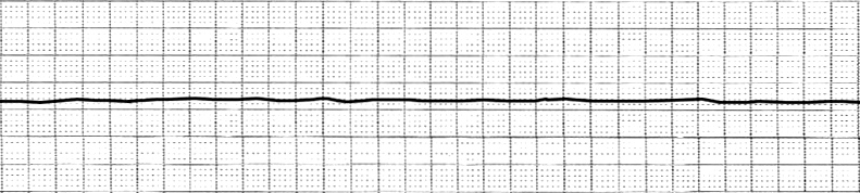File:EKG Asystole.jpg