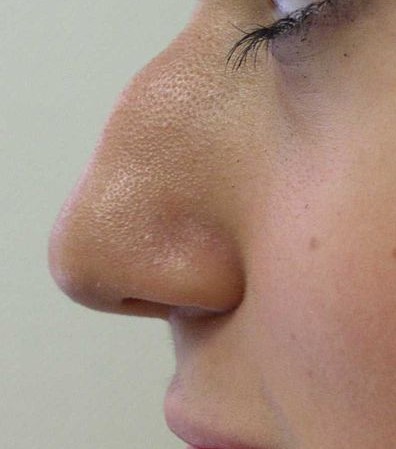 File:Hump nose2.jpg