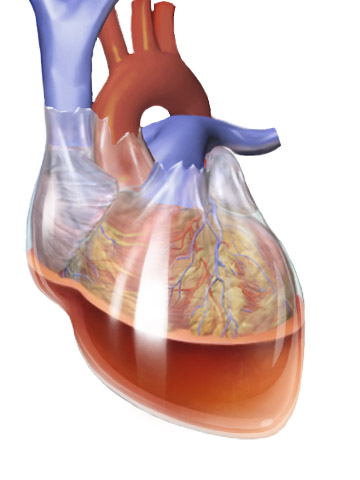 File:Blausen 0164 CardiacTamponade 02.png