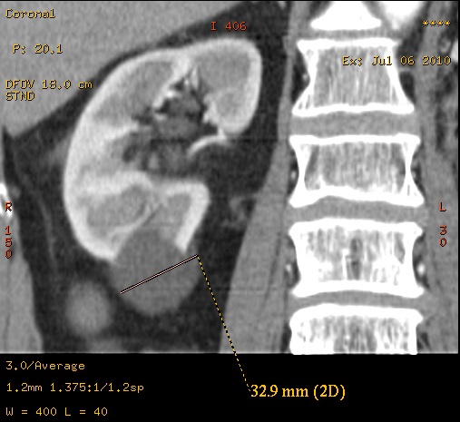 File:Simple renal cyst.jpg