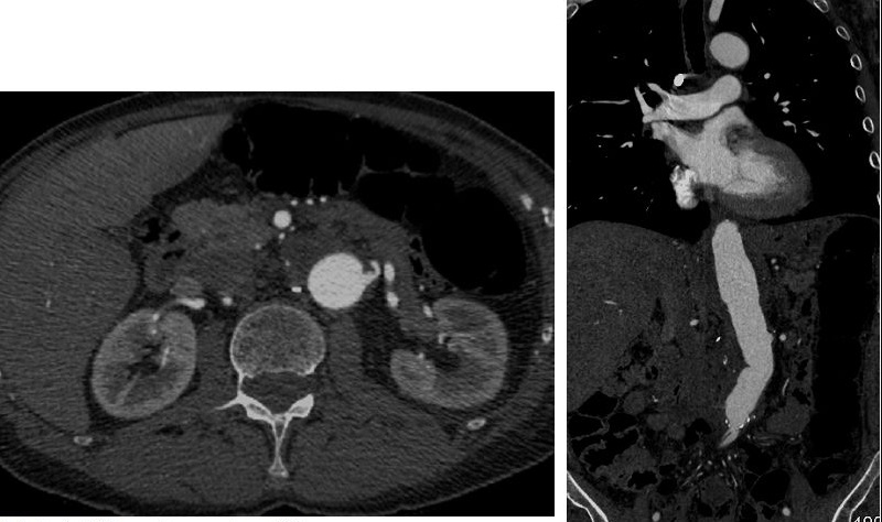 File:Abdominal CT angiography.jpg