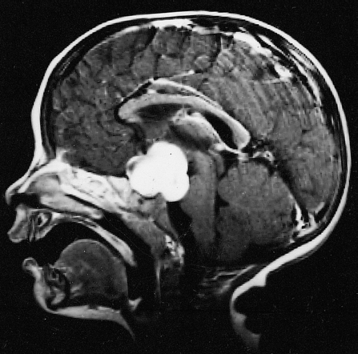 File:405615R-PA-HYPOTHALAMIC.jpg