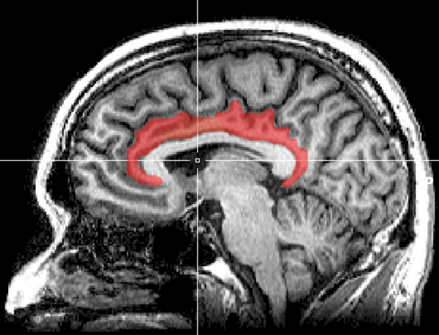 File:Brain MRI.png