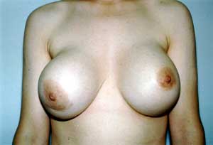File:Capsular fibrosis.jpg