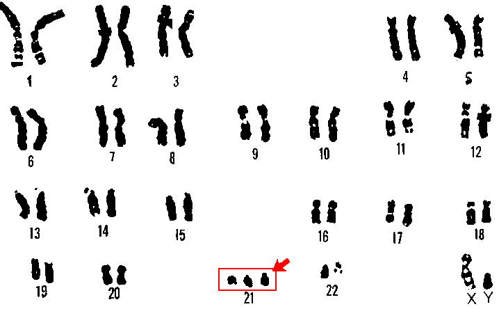 File:21 trisomy - Down syndrome.png