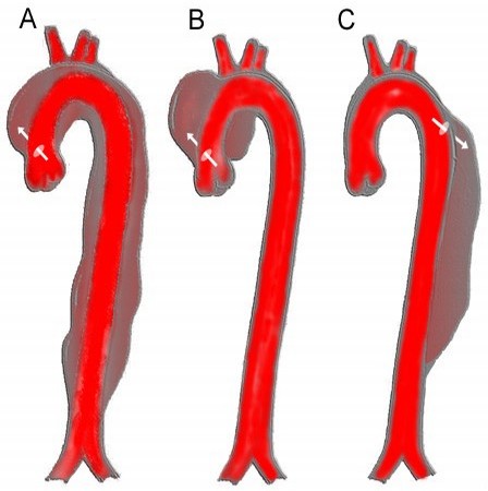 File:Aortic dissection class.jpg