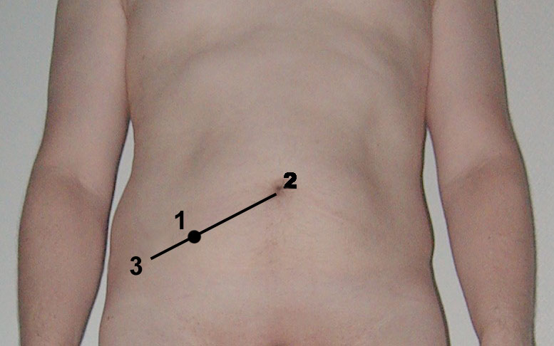 File:McBurney's point.jpg