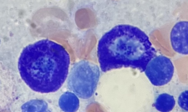 File:Mast cells in bone marrow.jpg