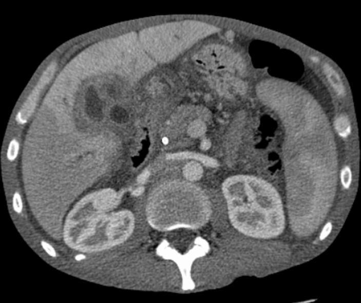File:CT cholangioca.jpg